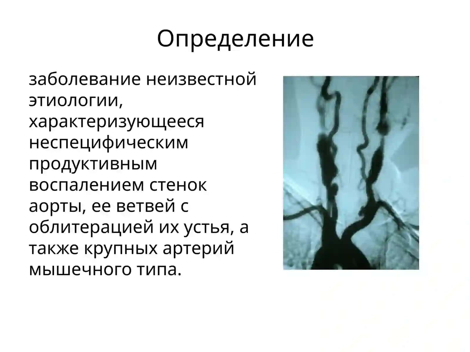 БолезньТакаясу(неспецифическийаортоартериит, синдромдугиаорты) 2