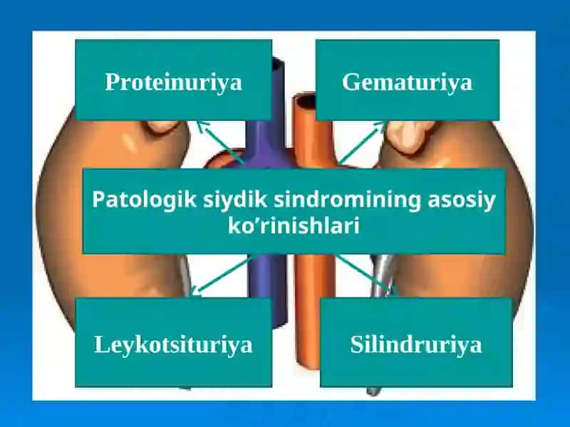 Proteinuriya Haqida Ma'lumot 2