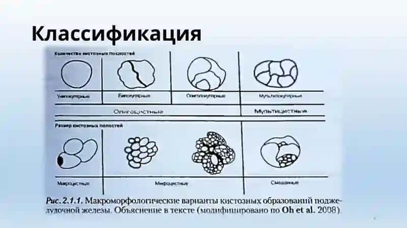 Кисты и кистозные опухоли поджелудочной железы 2