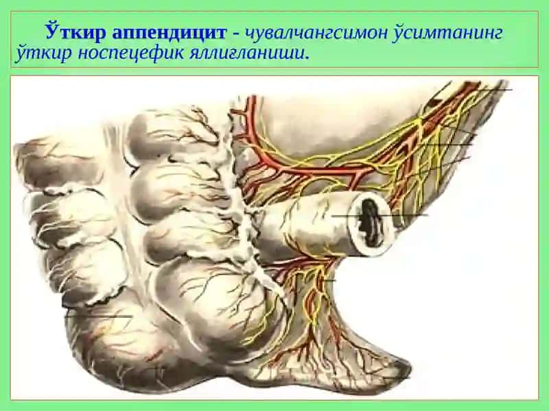 Ўткир аппендицит 2