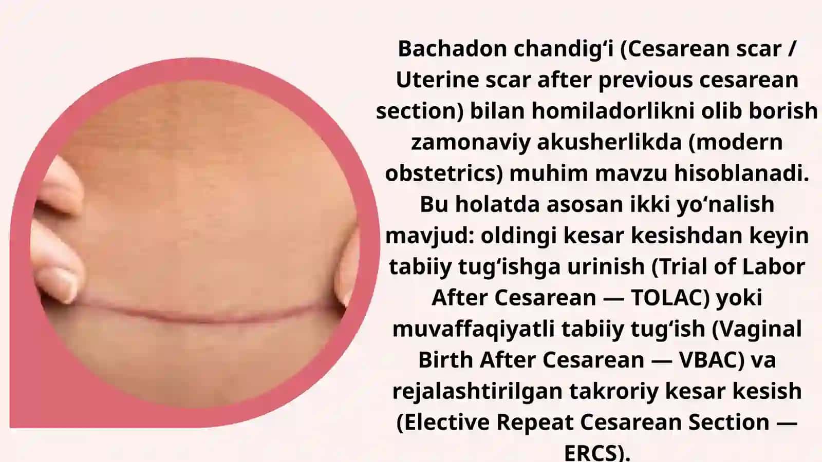 Bachadon chandigʻi bilan homiladorlikni olib borish 2