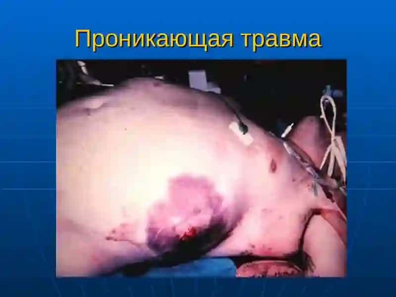 Травма Живота 2