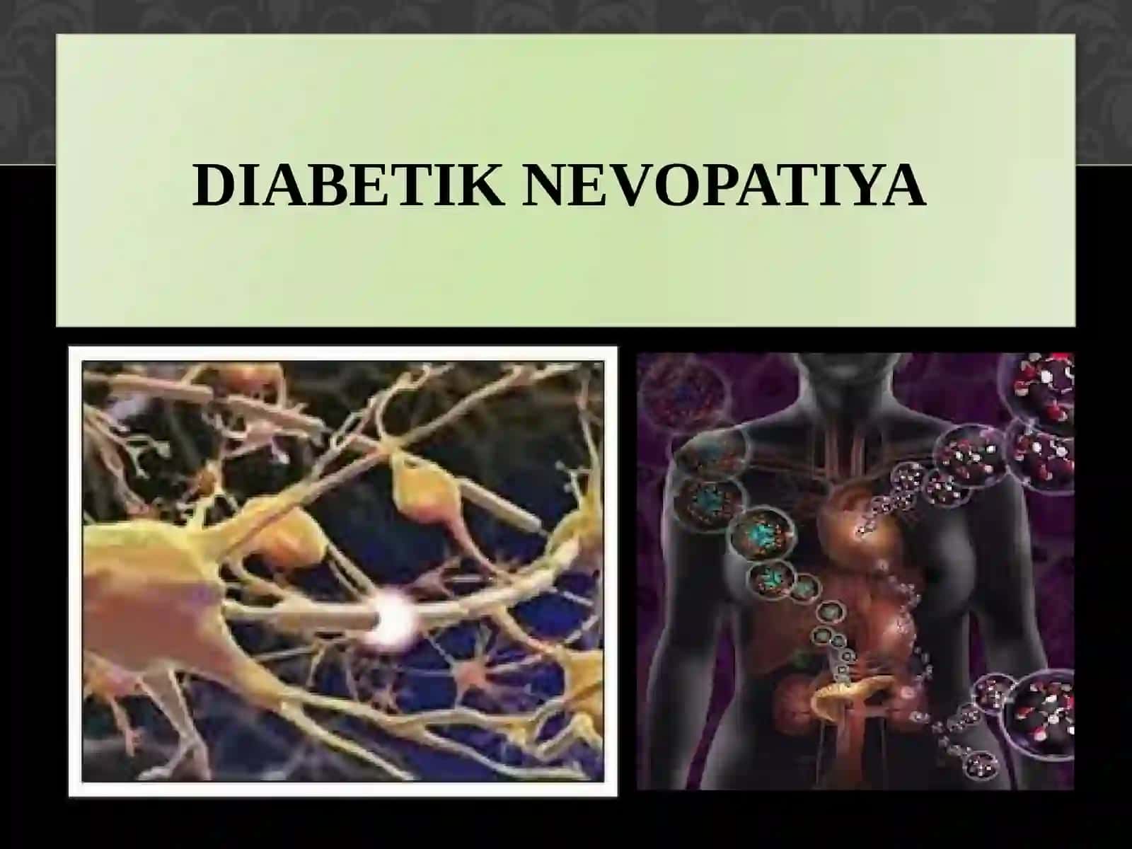 Diabetik nevopatiya 2