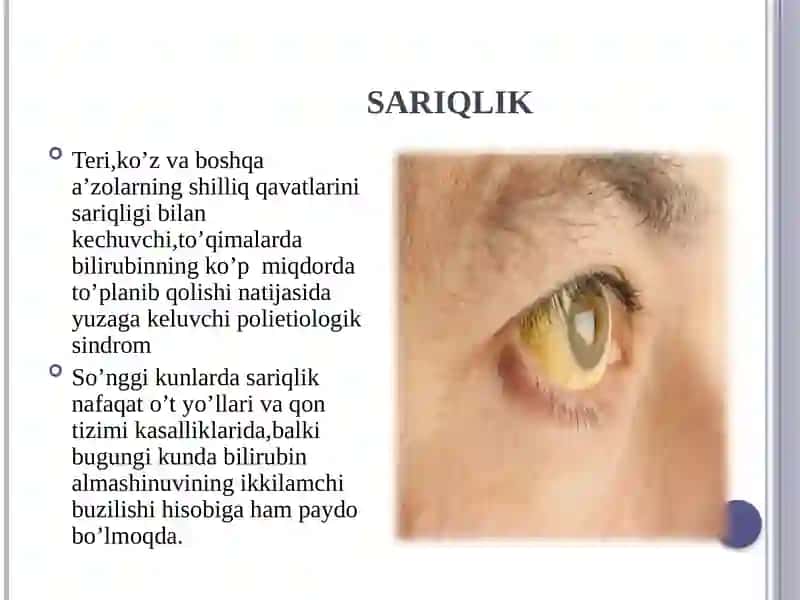 SARIQLIK SINDROMI BILAN KECHADIGAN YUQUNLI VA YUQUMLI BO’LMAGAN KASALLIKLARINING ERTA VA QIYOSIY TASHXISI 2