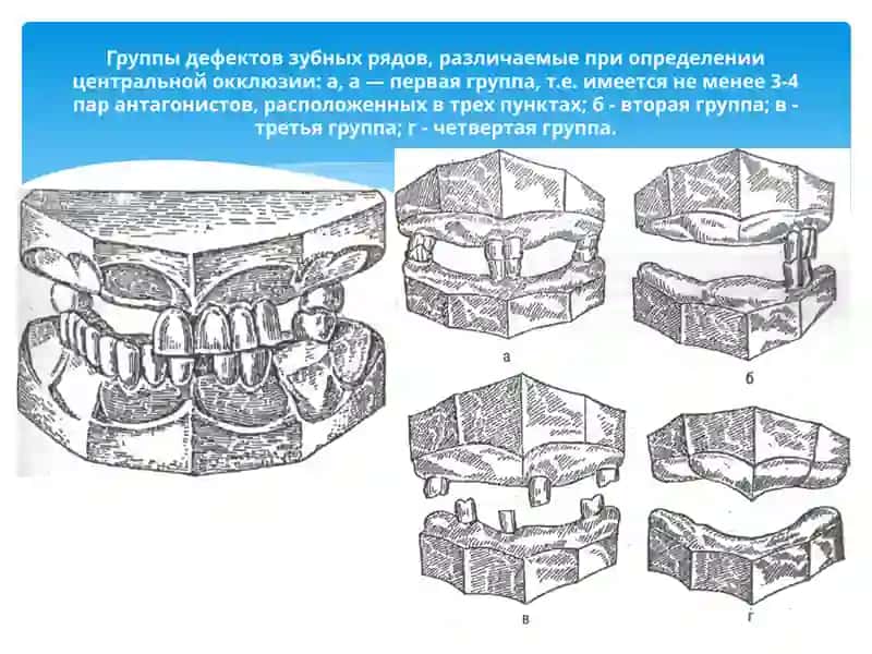 Марказий окклюзияни аниқлаш асослари ва сунъий тишларни териш асослари 2