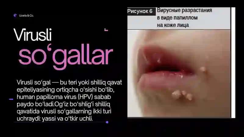 Virusli so‘gallar 2