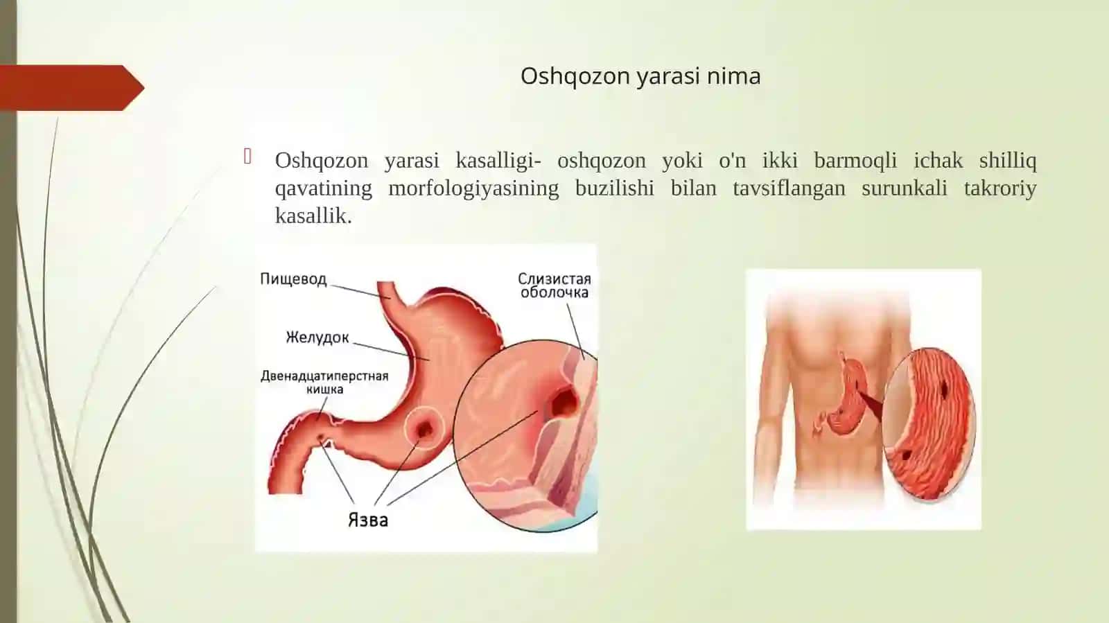 Oshqozon ichak yarasi kasalligining 1,2, va 3 lamchi profilaktikasi 2