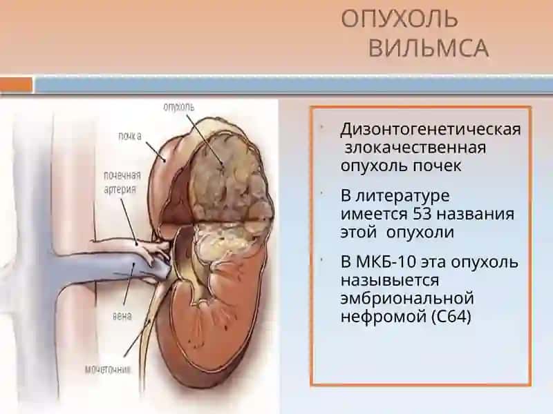 Нефробластома 2