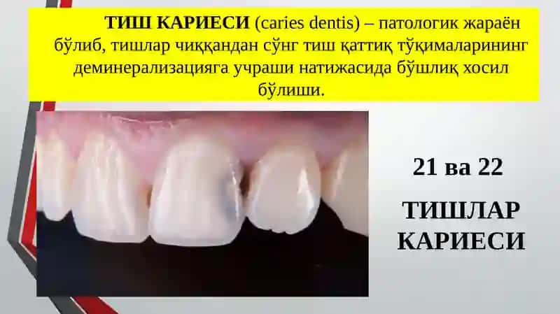 Тишлар кариеси синфлари буйича тасниф 2