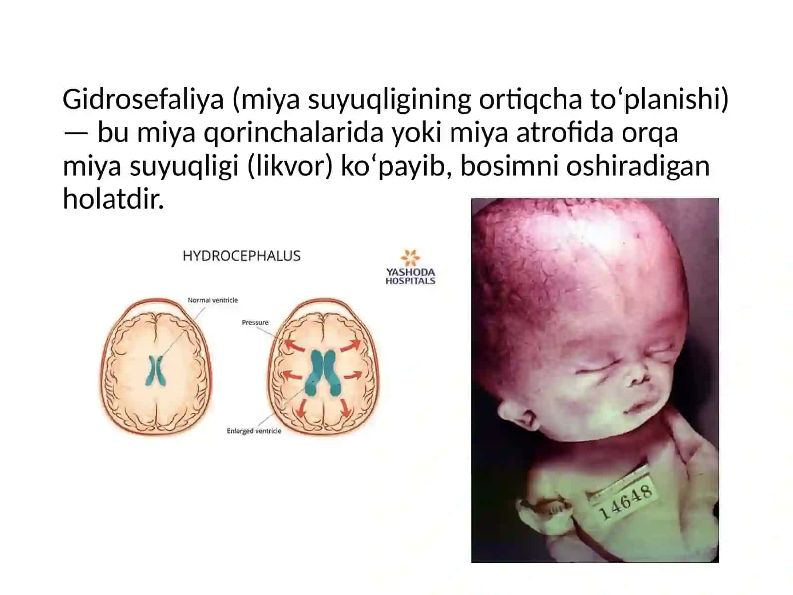 Gidrosefaliyada qo'llaniladigan zamonaviy davolash usullari 2