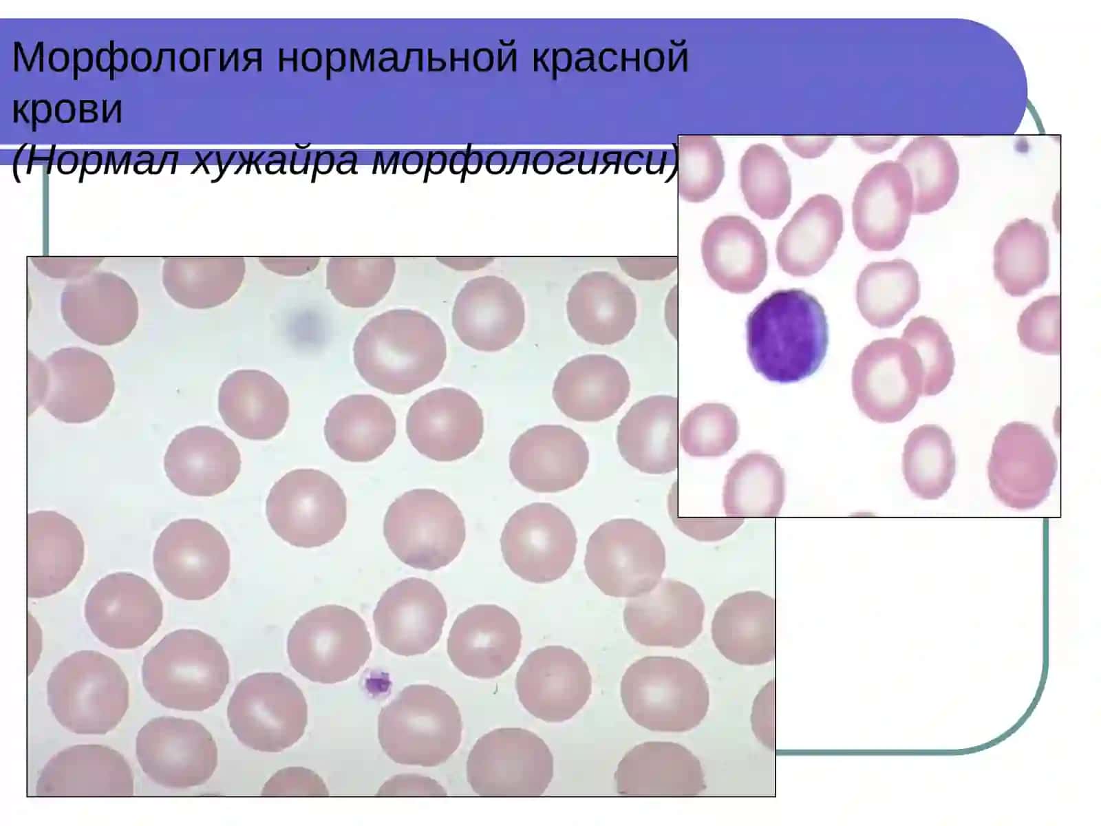 Анемии хронических заболеваний( Сурункали касалликлар Камконликлари)КАФ. КЛД 2