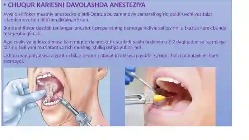 CHUQUR KARIESNI DAVOLASH 2