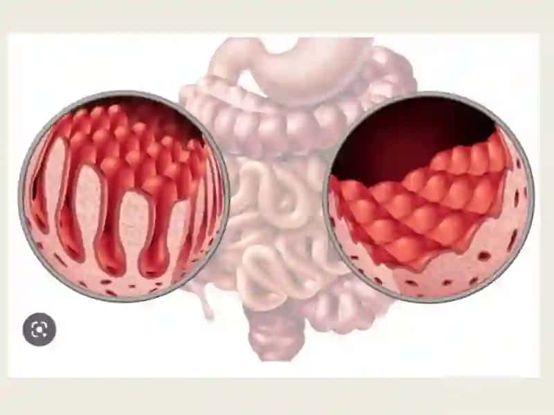Malabsorbsiyasindromi 2