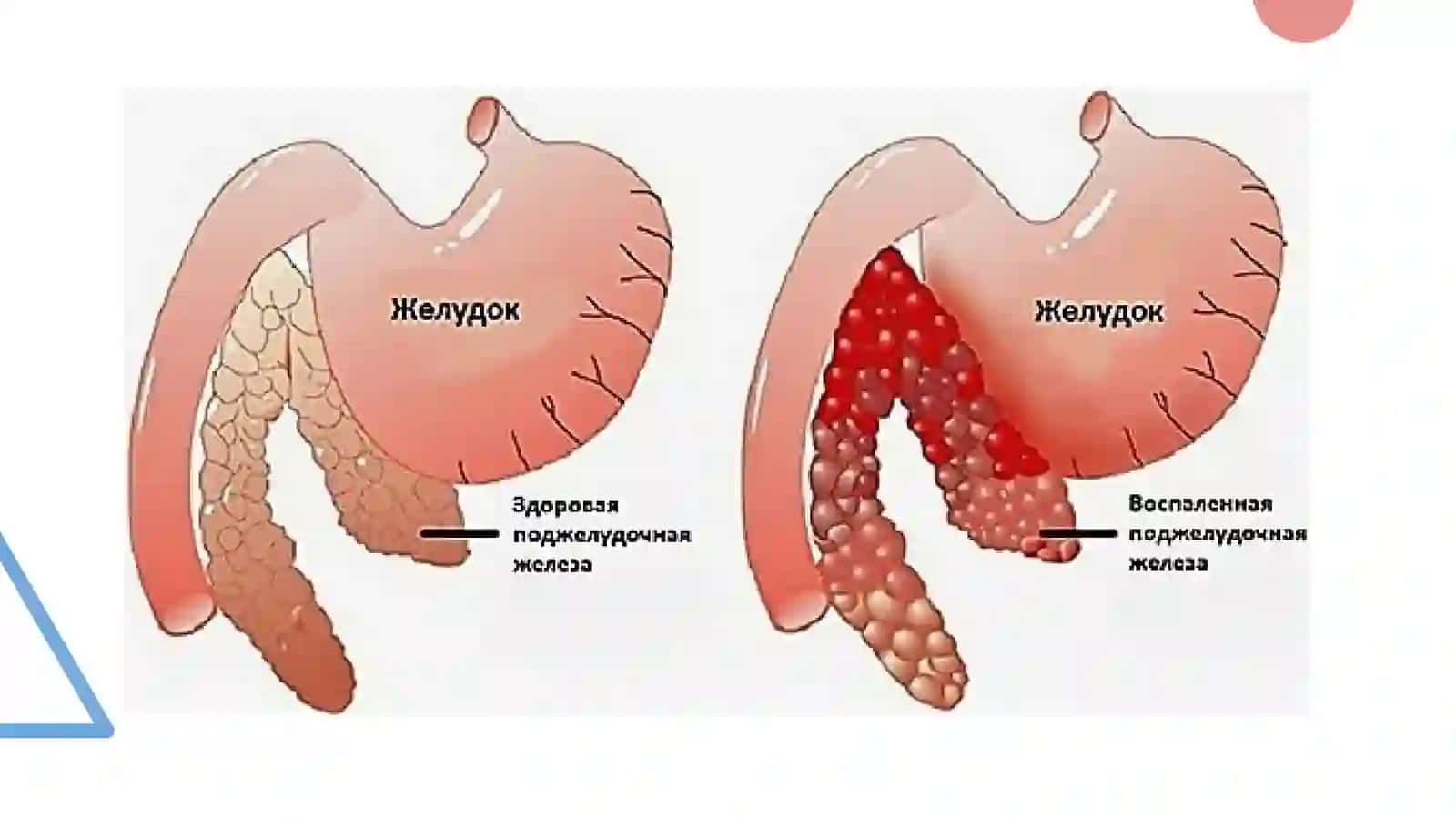Pankreatit rivojlanishining biokimyoviy asoslari. Davolash va diagnostika tamoyillari 2