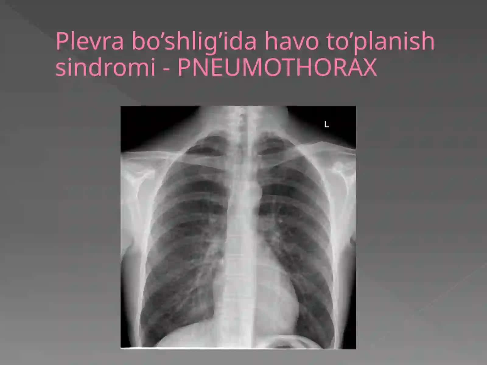 Plevrabo’shlig’idahavoto’planishsindromi 2