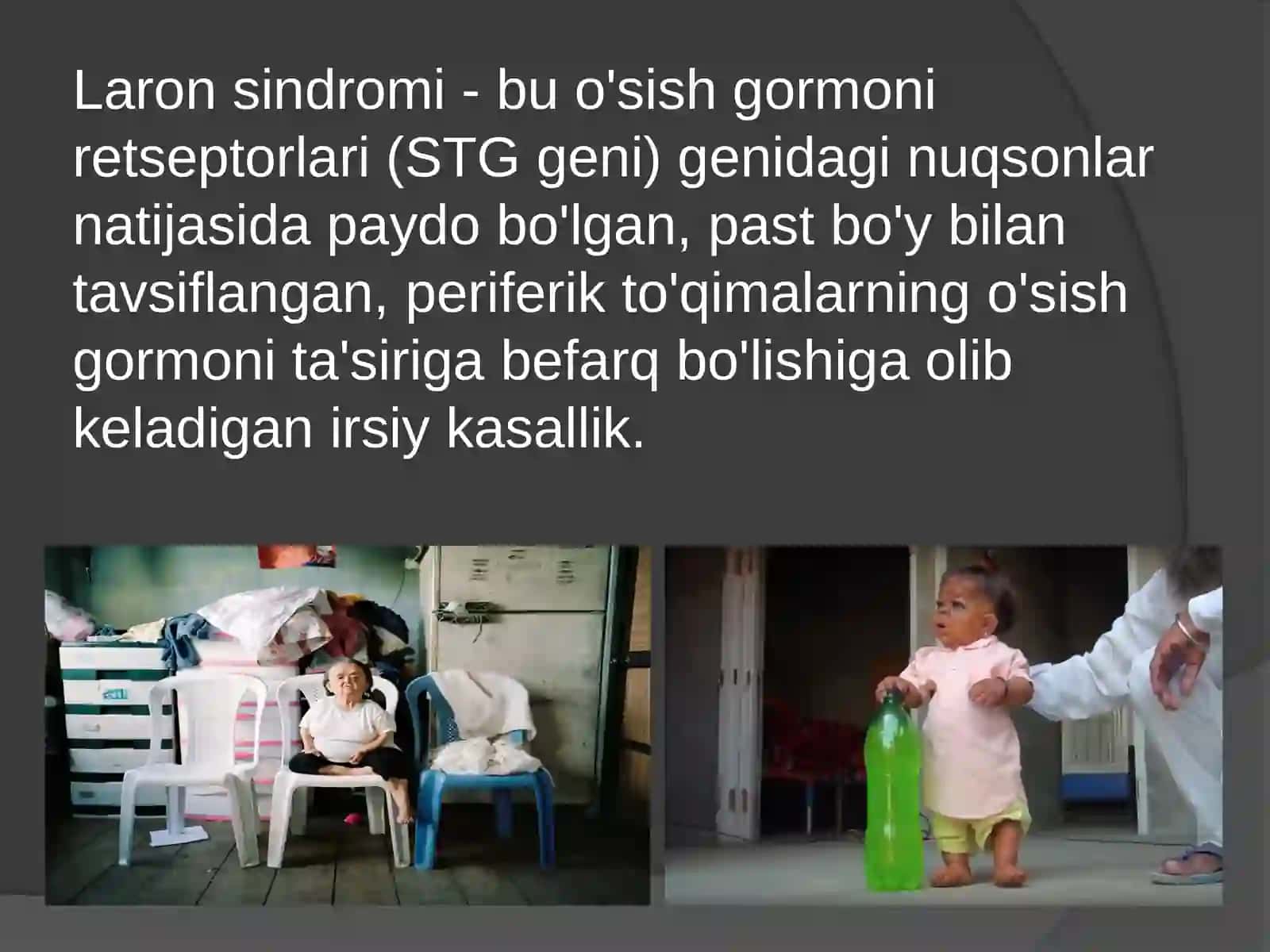 Laron Sindromi 2