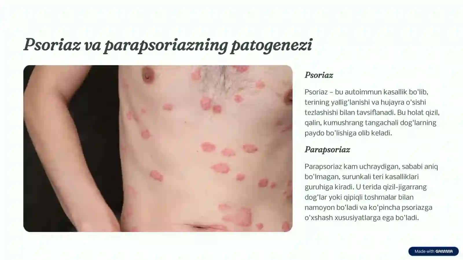 Parapsoriaz. Psoriaz va boshqa dermatozlarda davolashda kvant (PUVA, lazeroterapiya) terapiyaning zamonaviy asoslari 2