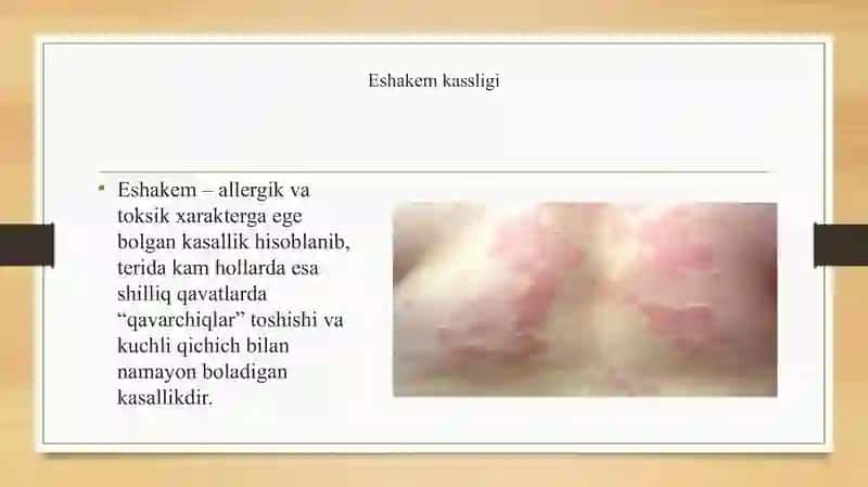 Eshakym kasalligi | Eshakem kasalligi prezintatsiya 2