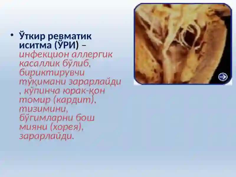 Ўткир ревматик иситма. 2