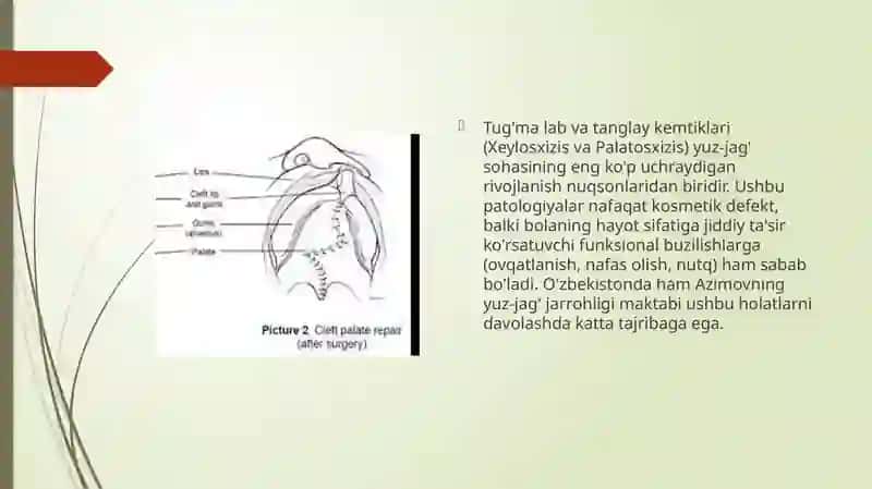 Tug'ma lab va tanglay kemtiklari 2