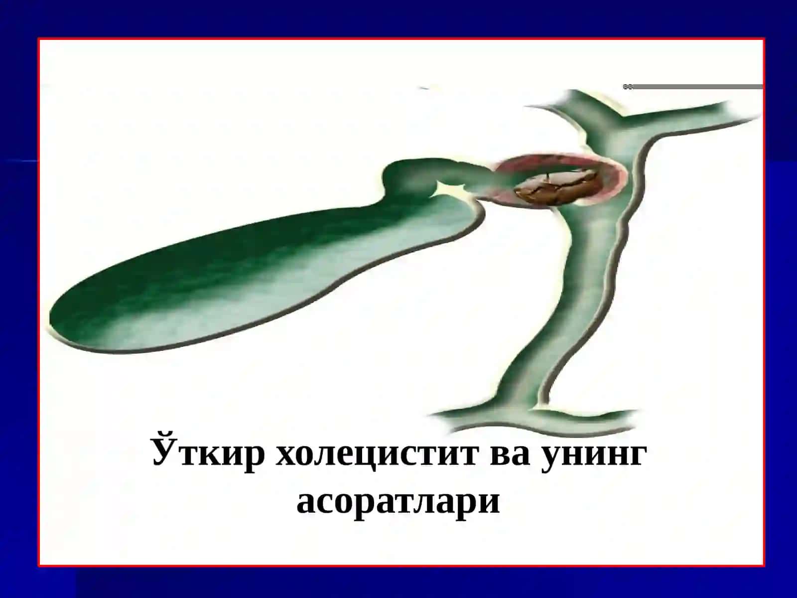 ЎТКИР ХОЛЕЦИСТИТ 2