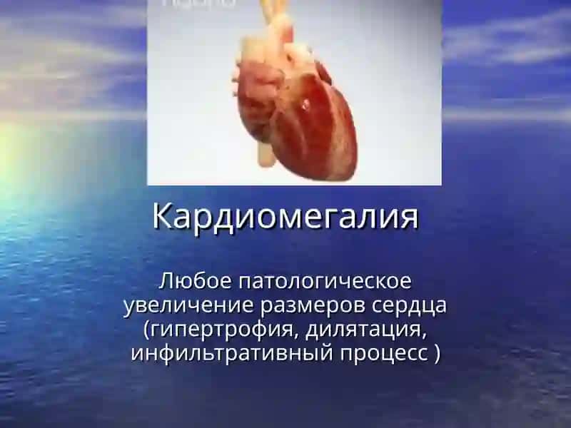Кардиомегалия 2