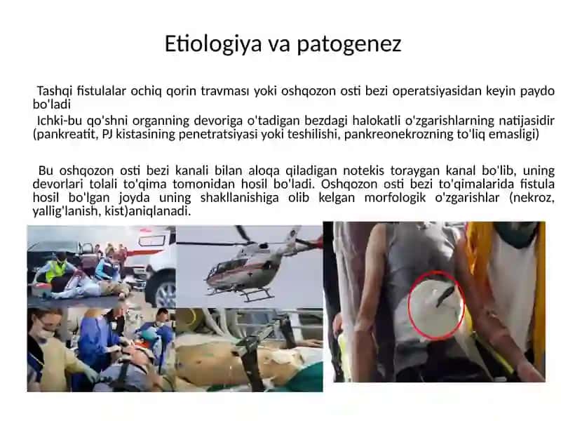 Oshqozonosti bezi fistulalari 2