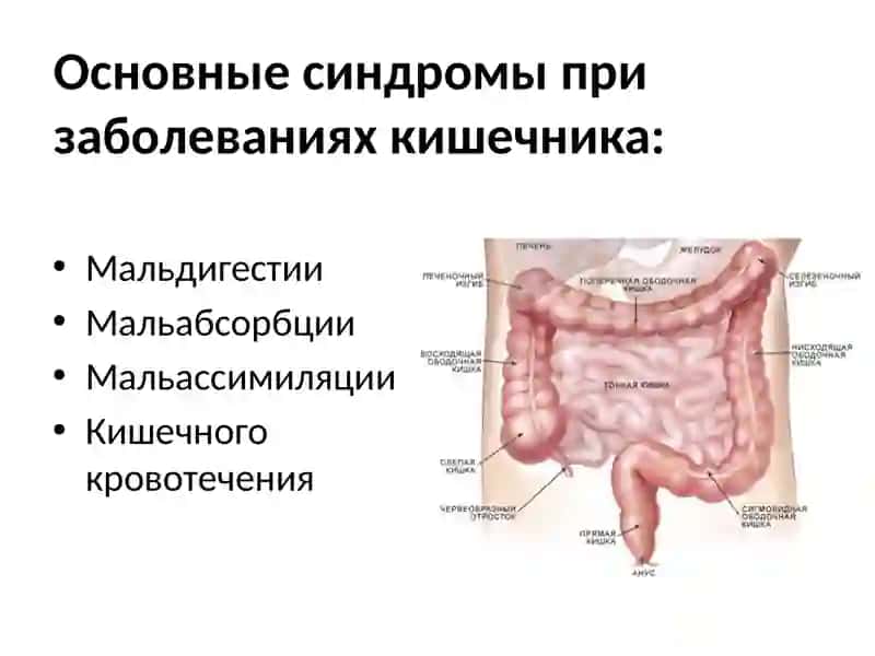 ОСНОВНЫЕ СИНДРОМЫ ПРИ  ЗАБОЛЕВАНИЯХ КИШЕЧНИКА 2