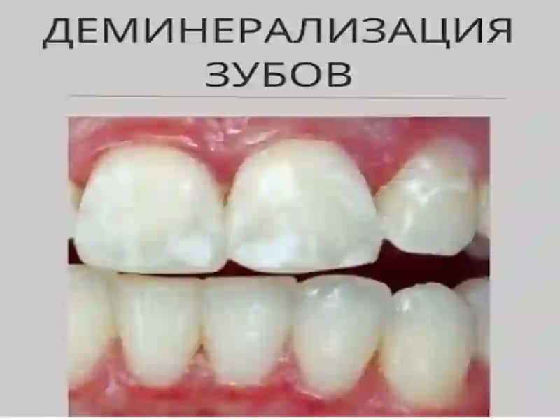 Tish deminerilizatsiyasi 2
