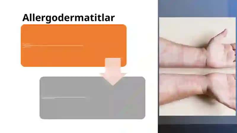 Allergodermatitlar 2