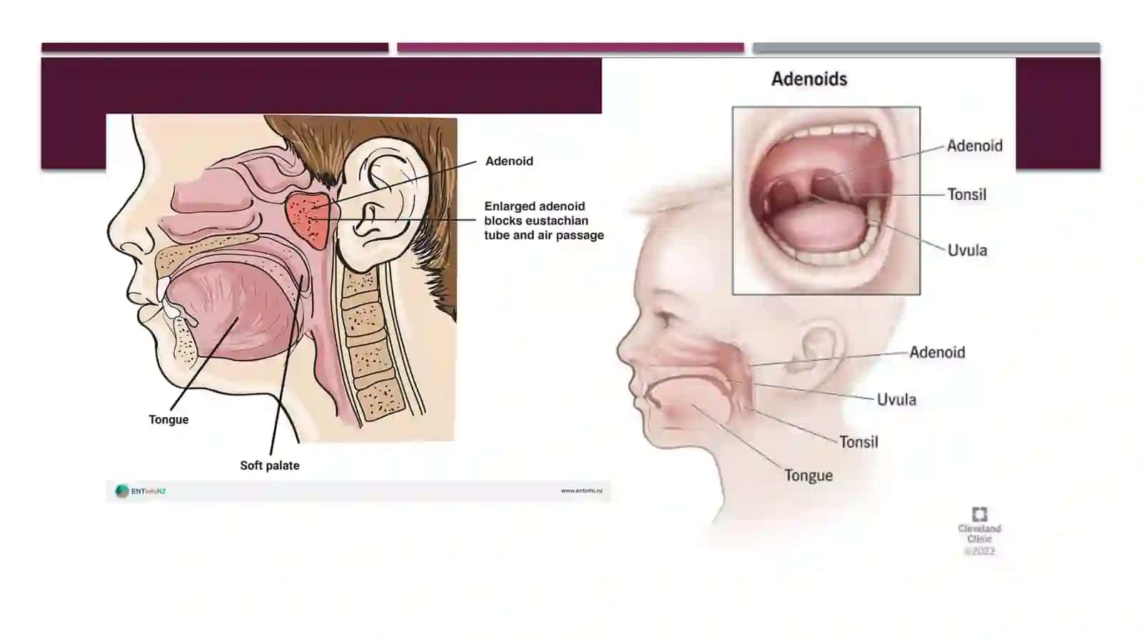Adenoidlar 2