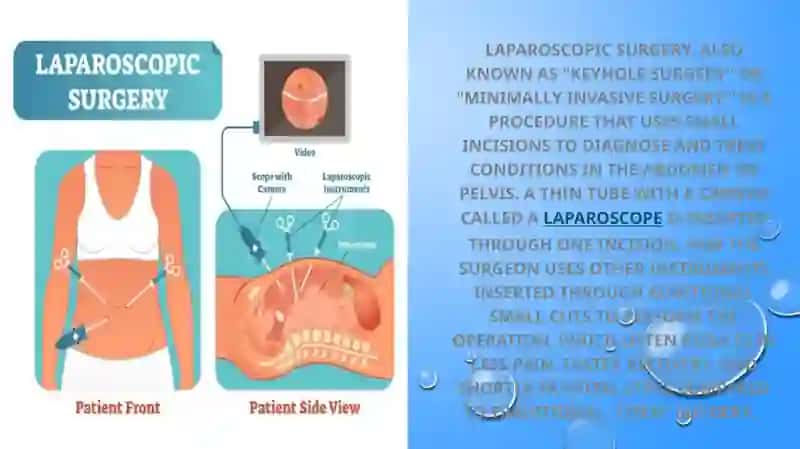 Laparoscopic Surgery. Laparoscopic Splenectomy. Surgery of the Pancreas. Biliodigestive Anastomose 2