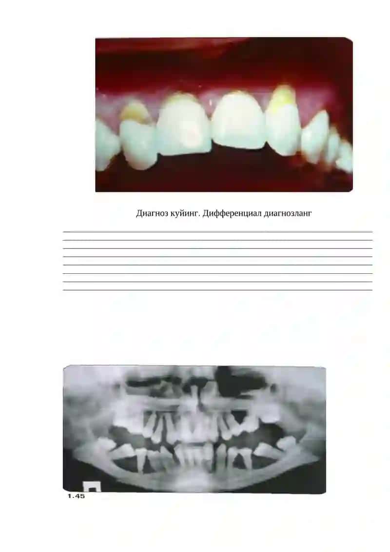 Qon kasalliklarida parodontdagi o'zgarishlar (neytropeniya, akatalaziya, gipoimmunoglobulinemiya) 2