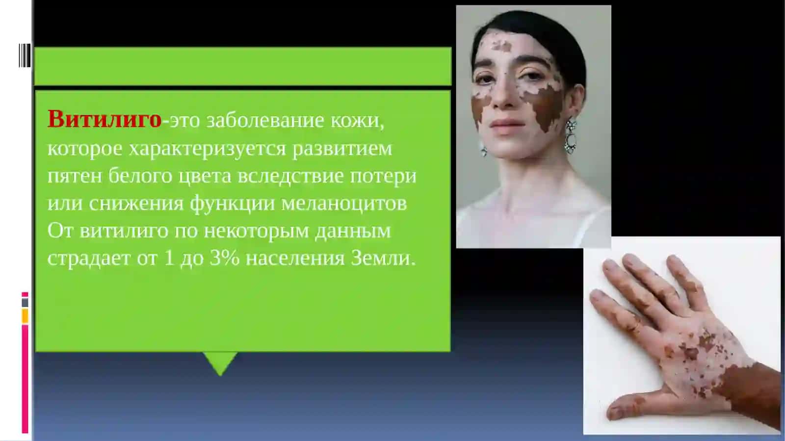 Витилиго 2