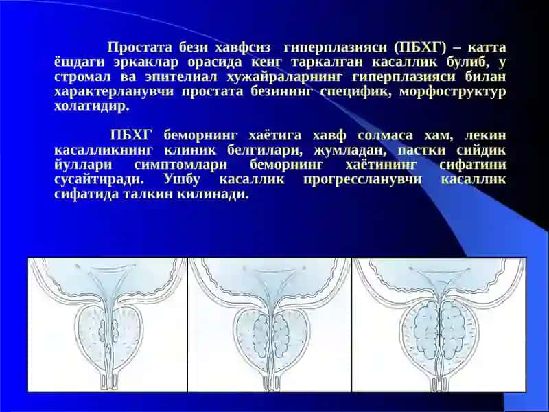 Простата бези хавфсиз гиперплазияси 2