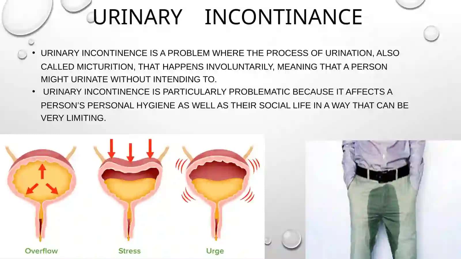 URINARY INCONTINANCE 2