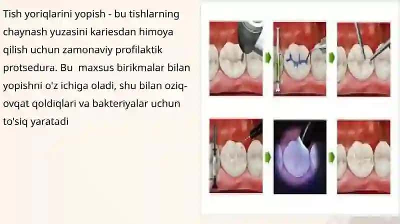Fissur germatiklar 2
