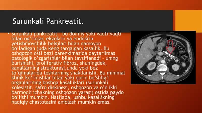 Surunkali pankereatit kasalligi 2