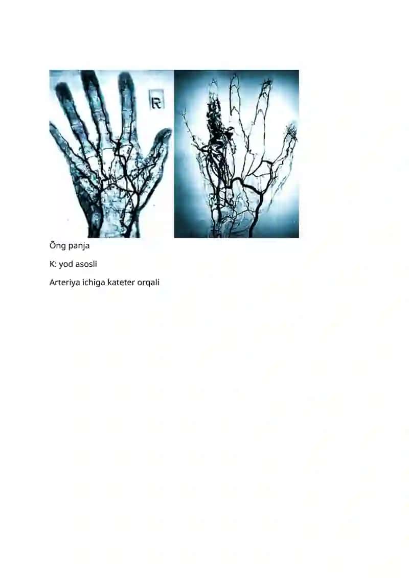 Rentgen angiografiya 2