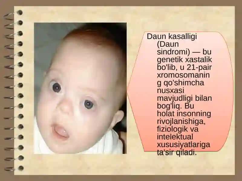 Daun sindromi 2