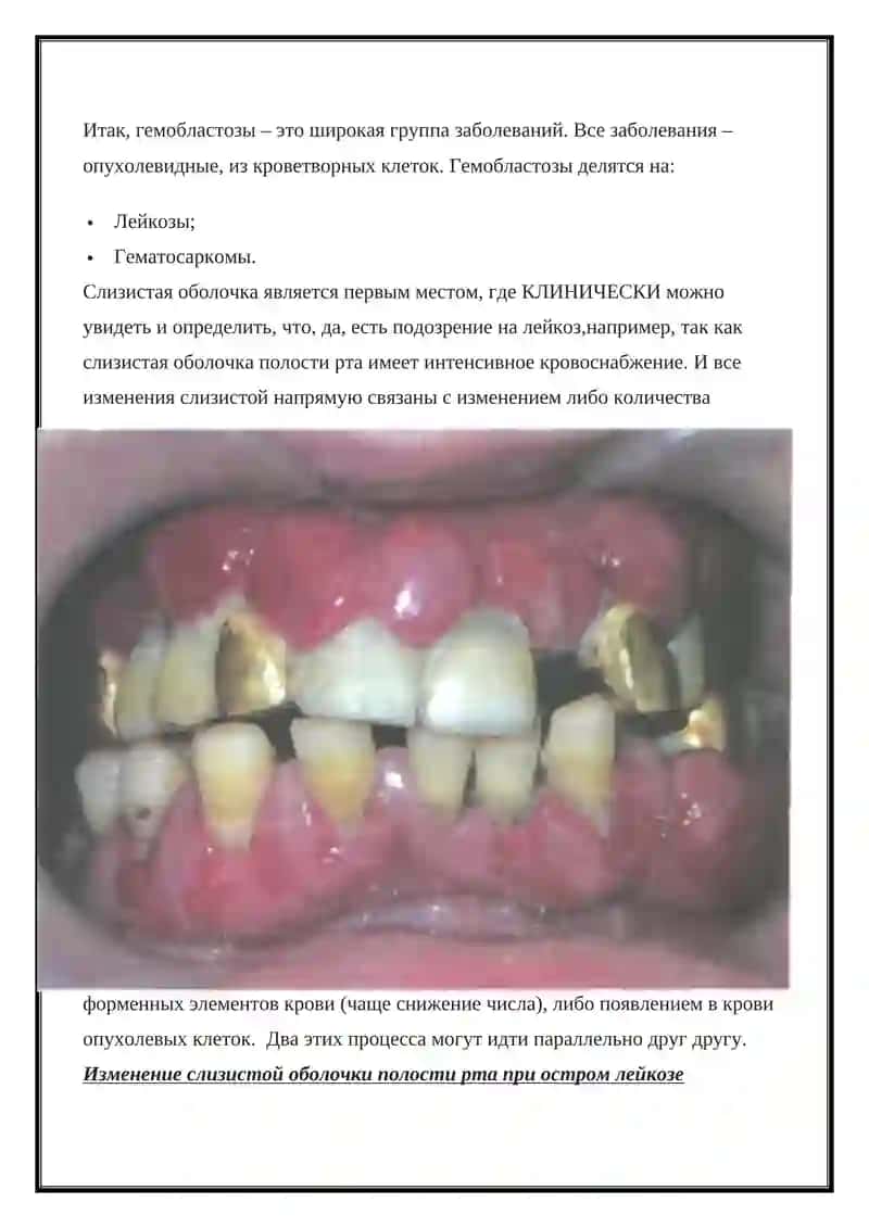 Гемобластозы 2