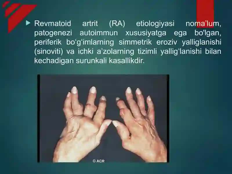 Revmatoid artrit 2