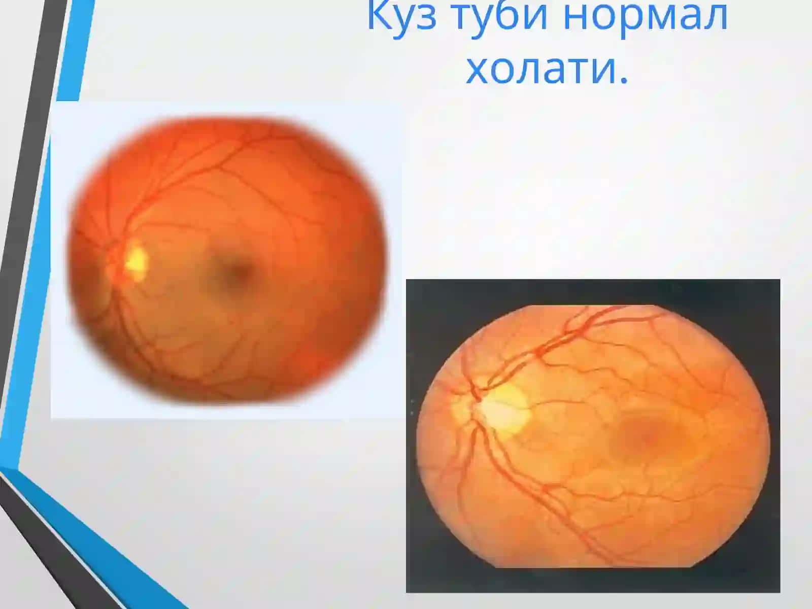 Умумий касалликларда кузатиладиган кўздаги патологик ўзгаришлар 2