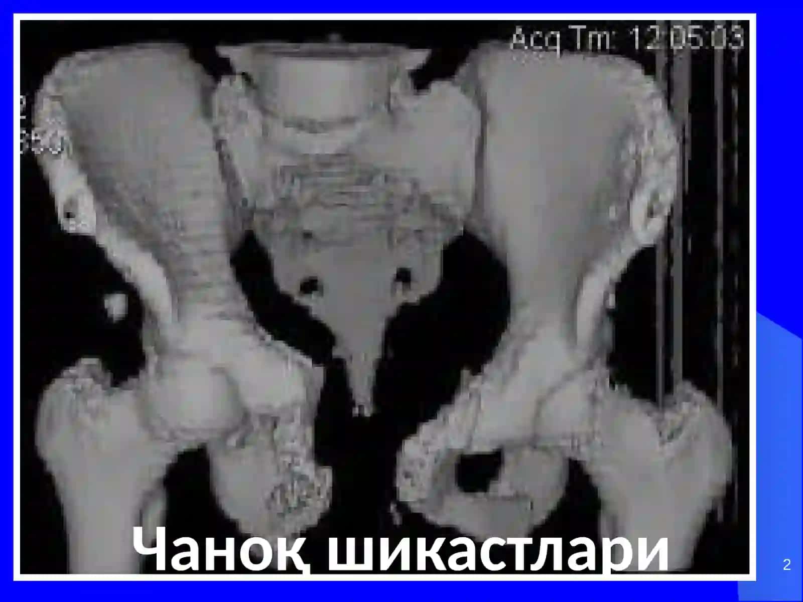 Чаноқ шикастлари 2
