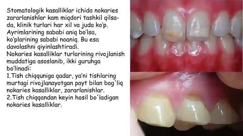 nokarioz kasalliklar 2