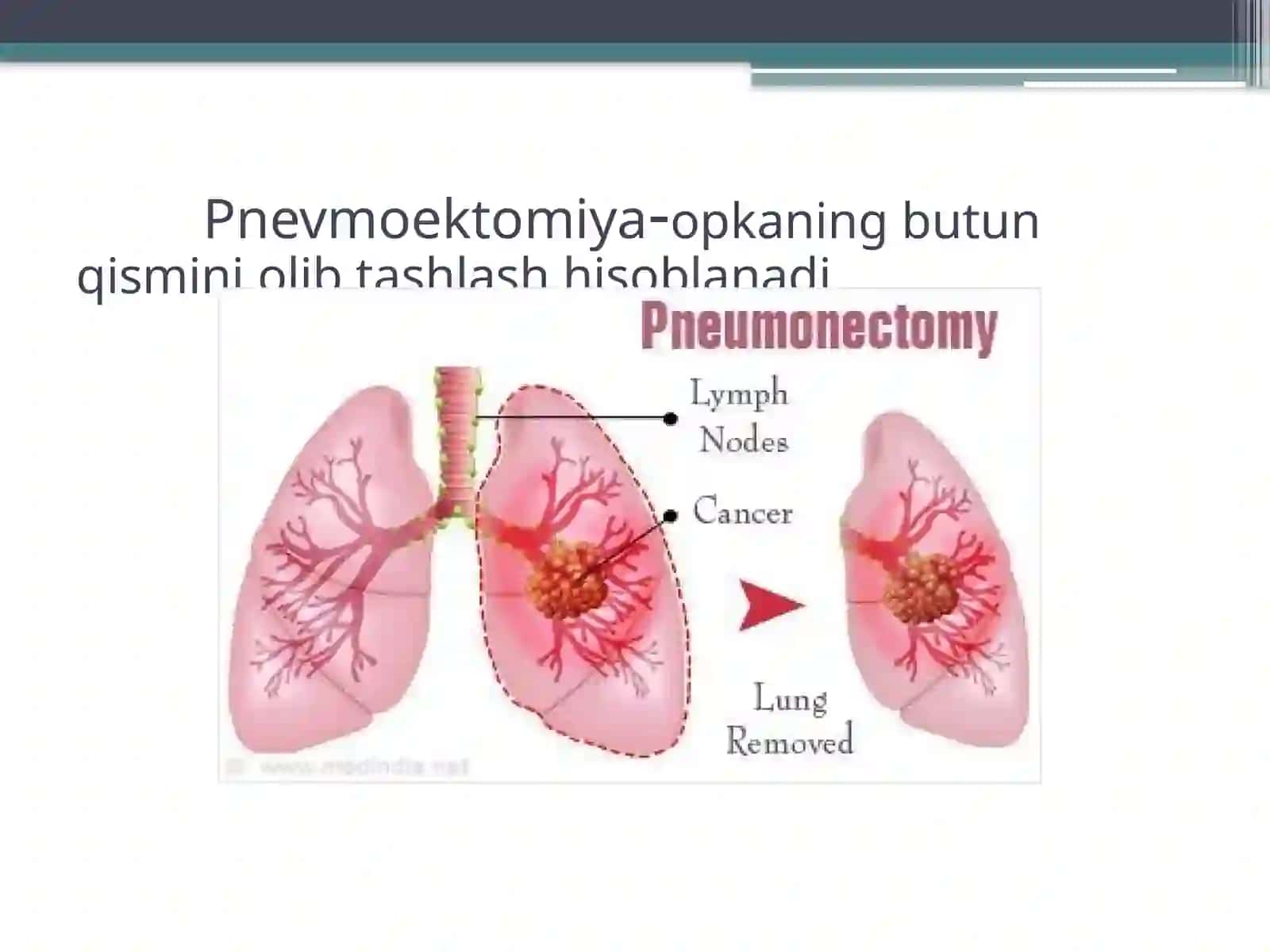 Pnevmoektomiya 2