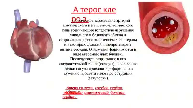 Атеросклероз 2