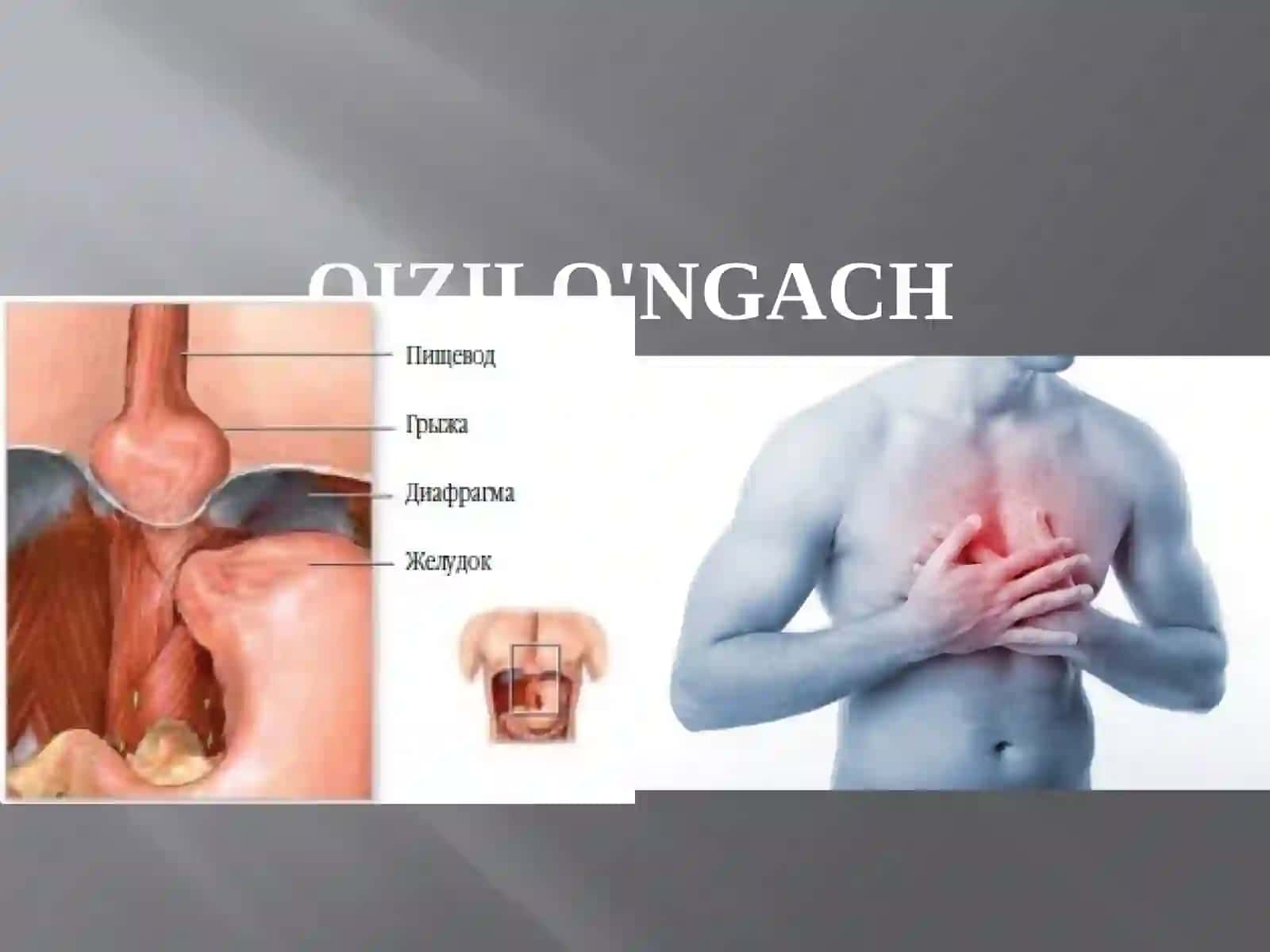 Qizilo'ngach kasalliklari 2