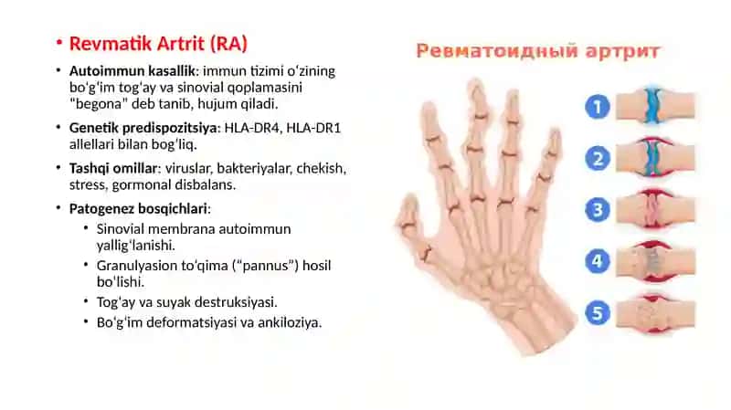Bo'g'im sindromi batafsil pptx taqdimot 2