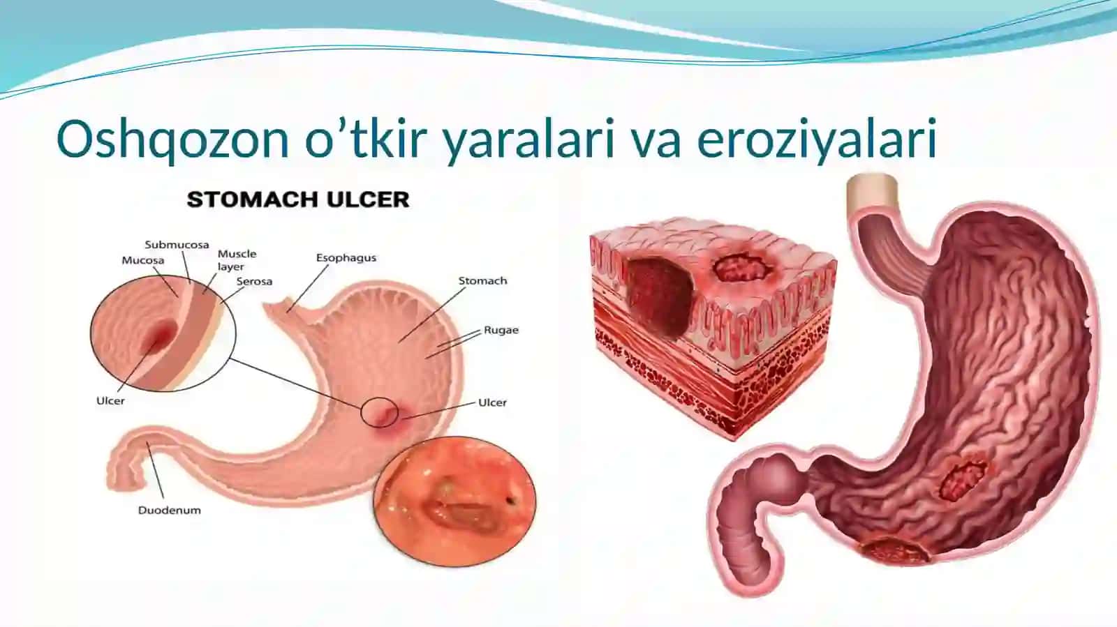 Oshqozon o’tkiryaralari va eroziyalari 2